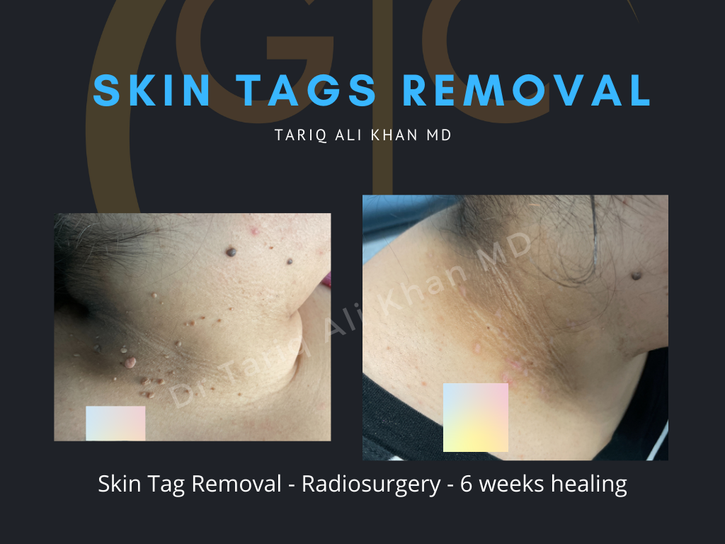 Gentle Care Laser Tustin Before and After picture - Skin Tags Removal